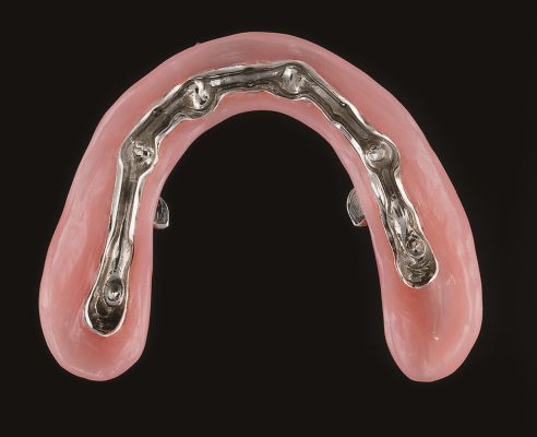 Oberkieferprothese von der Unterseite mit Stegreiter