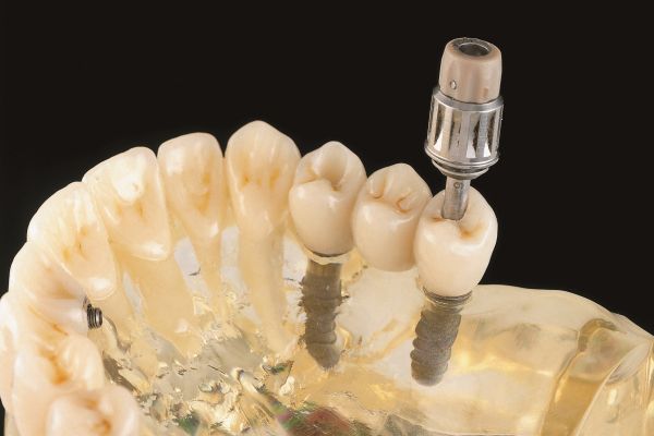 Implantataufbau ist eine wichtige Grundlage für solide Implantate