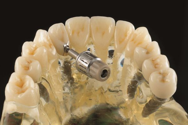 Implantatkronen mit Kosten und Materialien