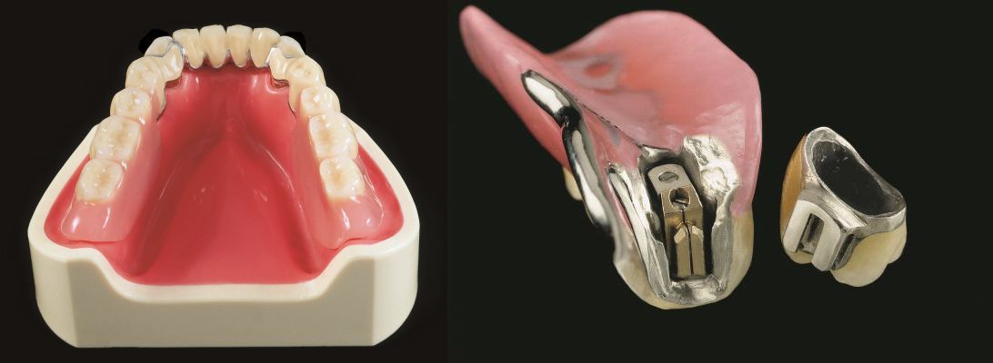Teilprothesen aus verschiedenen Materialien