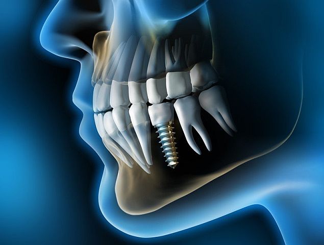 Implantataufbau ist eine wichtige Grundlage für solide Implantate