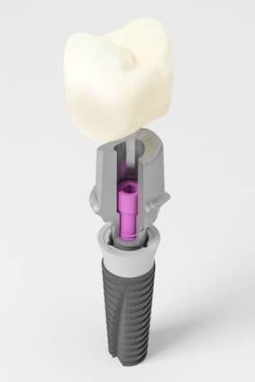 Individuelle Abutments