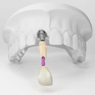 Implantatbrücken Kosten und Materialien