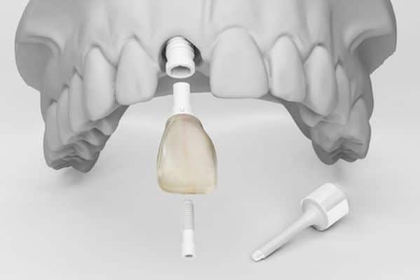 Zirkonimplantate mit hoher Qualität und geringen Kosten