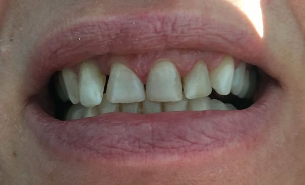 Non-prep Veneers