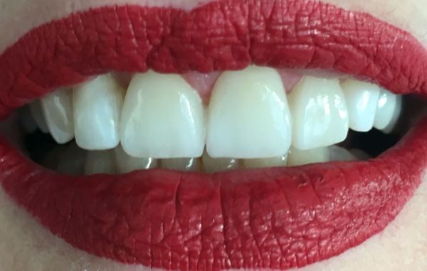 TEST-VENEERS zu bestimmten Anlässen