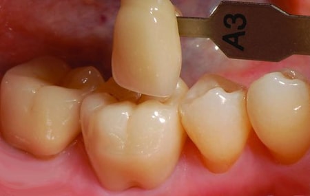 Zahnkronen aus unterschiedlichen Materialien