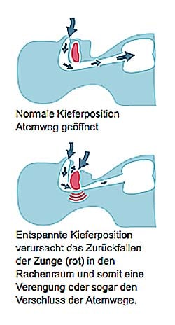 Schnarchschienen verhindern Schnarchen