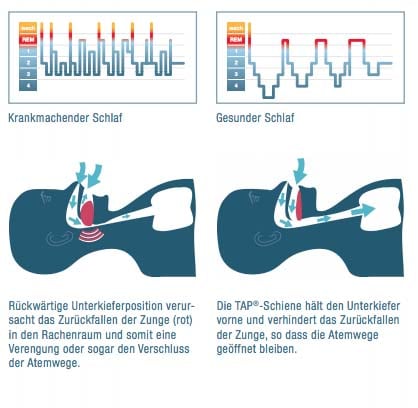 Schnarchschienen verhindern Schnarchen