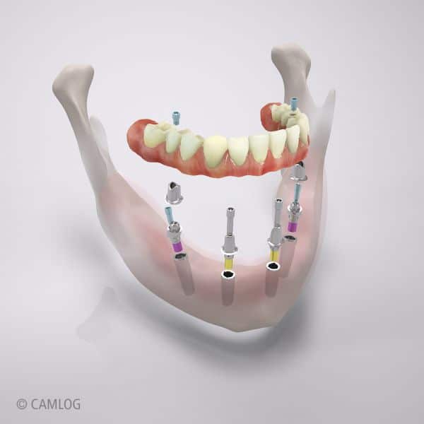 Implantatbrücken Kosten und Materialien