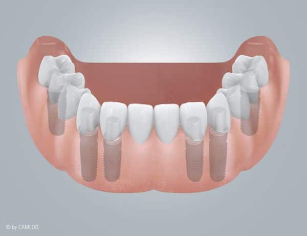 Totalprothetik im CADCAM-Verfahren