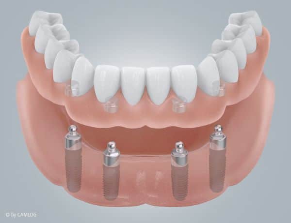 Druckknopfprothese perfekt verarbeitet