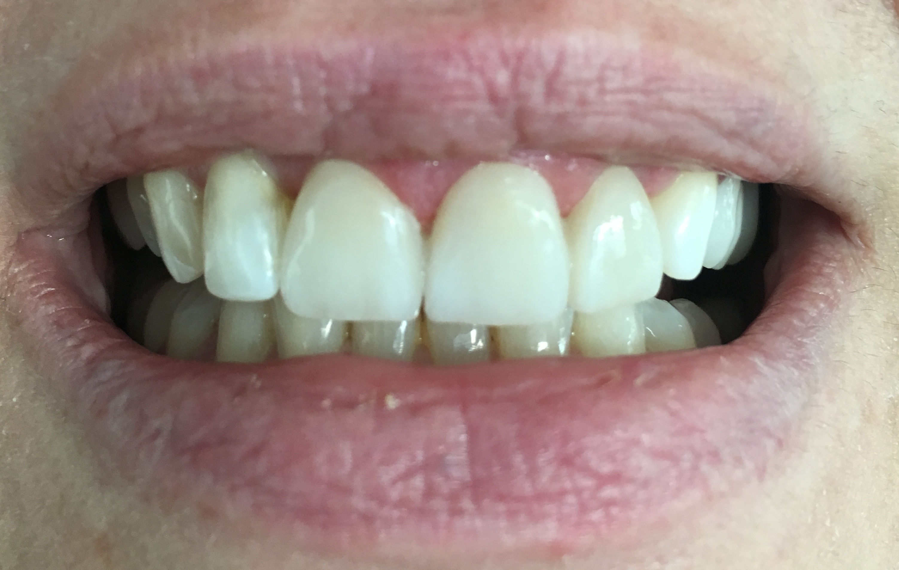 Non-prep Veneers