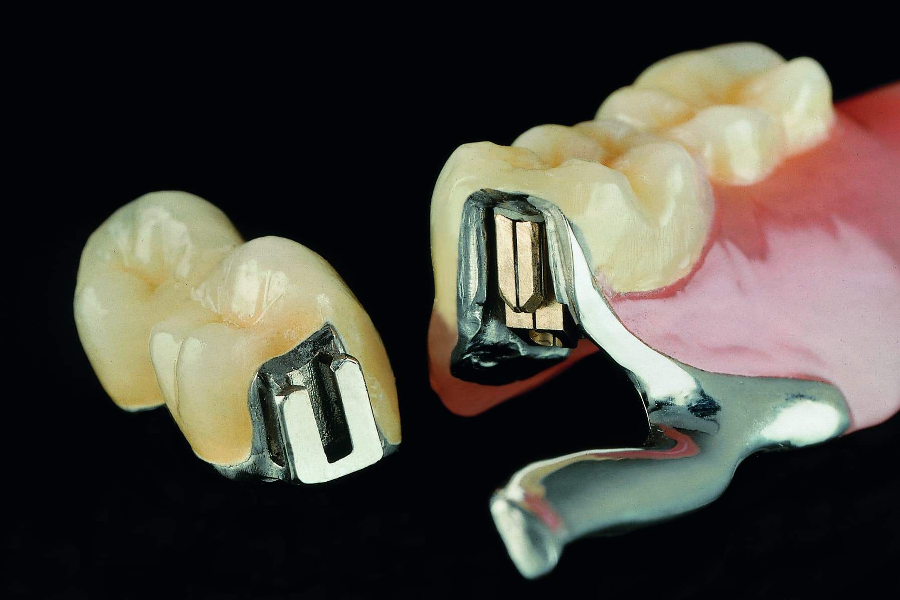 Geschiebeprothese aus verschiedenen Materialien