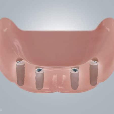 Druckknopf-Kugelanker auf vorhandenen Zahnstümpfen oder auf Implantaten